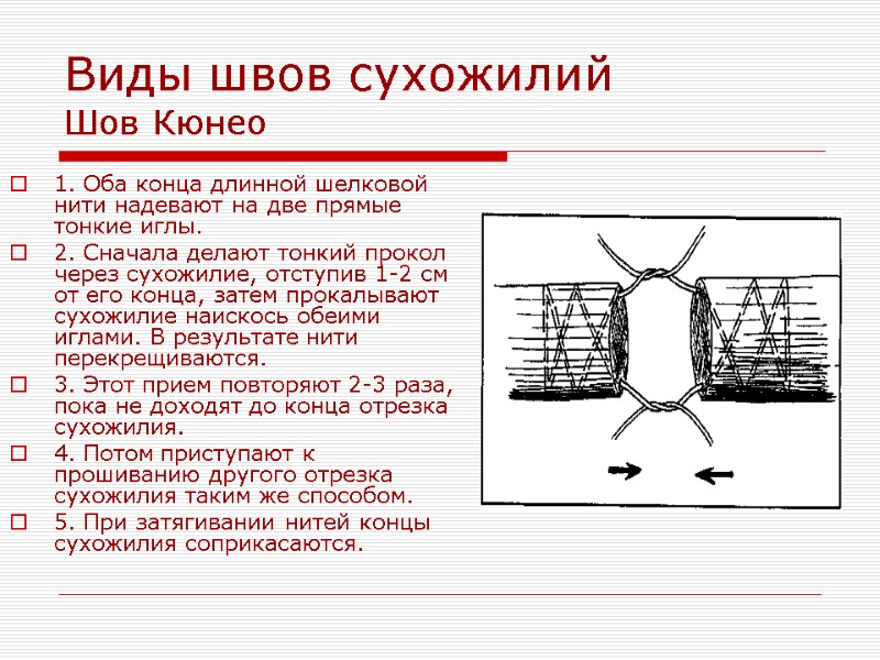 Виды швов сухожилий Шов Кюнео 1. Оба конца длинной шелковой нити надевают на две